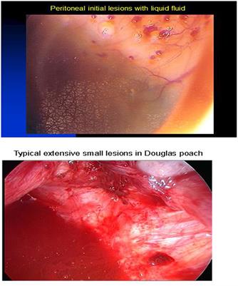 It Is Necessary to Purpose an Add-on to the American Classification of Endometriosis? This Disease Can Be Compared to a Malignant Proliferation While Remaining Benign in Most Cases. EndoGram® Is a New Profile Witness of Its Evolutionary Potential